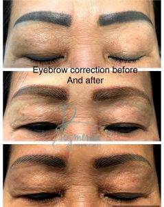 Permanent Makeup Correction and Removal - Pigmenta